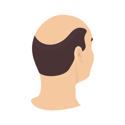 Alopecia (calvicie, caída del cabello)