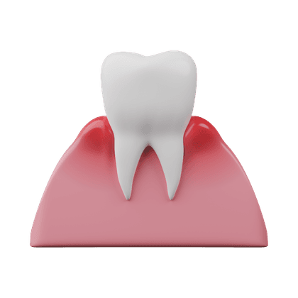 Inflamación de las encías, gingivitis, periodontitis